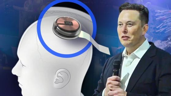 Neuralink của Elon Musk gặp sự cố sau ca cấy chip vào não người đầu tiên